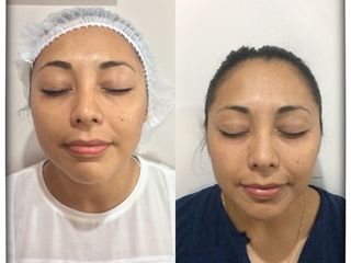 Antes y después de rejuvenecimiento Facial