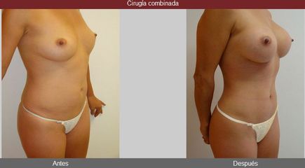 Antes y después de Cirugía combinada
