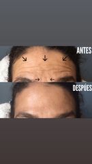 Antes y después de aplicación de Botox