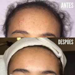 Antes y después de tratamiento facial 
