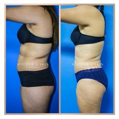 Antes y después de Liposucción