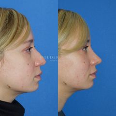 Antes y después de Rinoplastia