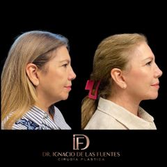 FACELIFT - Dr. Ignacio De Las Fuentes