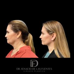 FACELIFT - Dr. Ignacio De Las Fuentes