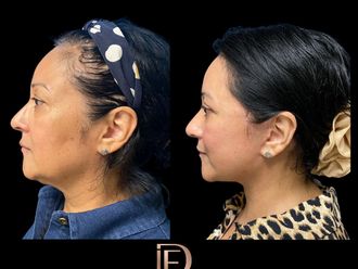 Cirugía facial antes y después - 866824