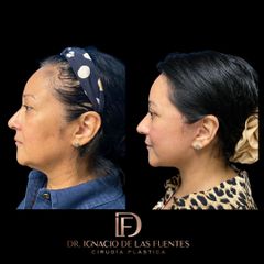 FACELIFT - Dr. Ignacio De Las Fuentes