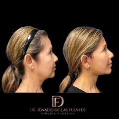 FACELIFT - Dr. Ignacio De Las Fuentes