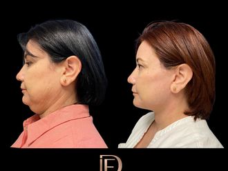 Cirugía facial antes y después - 866826