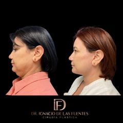 FACELIFT - Dr. Ignacio De Las Fuentes