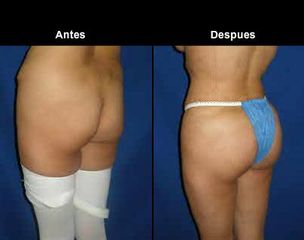 Antes y después de LIpoescultura