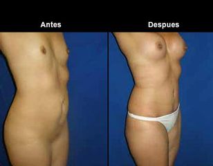 Antes y después de Liposucción 