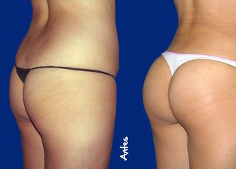 Antes y después de Gluteoplastia 
