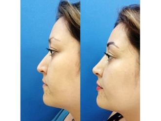Rinoplastia - 641655