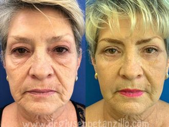 Blefaroplastia - 643743