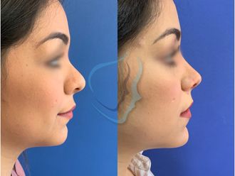 Rinoplastia - 686638