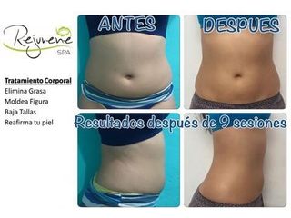 Radiofrecuencia - Rejuvene Medical Spa