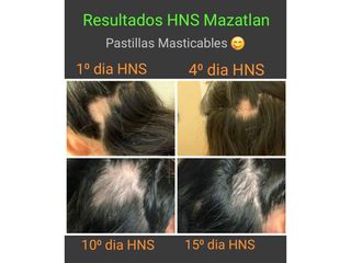 Alopecia - Rejuvene Medical Spa