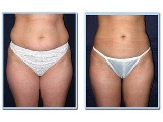 Liposucción - Rejuvene Medical Spa