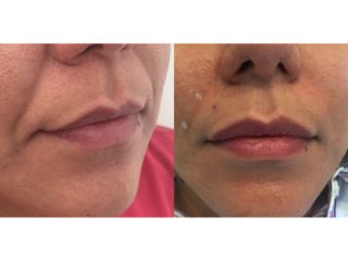 Aumento de labios - Rejuvene Medical Spa