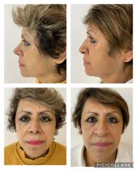 Rinoplastia - Cp Facial