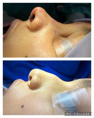 Rinoplastia - Cp Facial