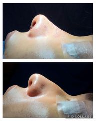 Rinoplastia - Cp Facial