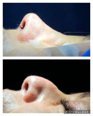 Rinoplastia - Cp Facial