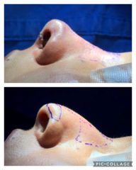 Rinoplastia - Cp Facial