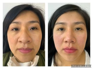 Rinoplastia - Cp Facial