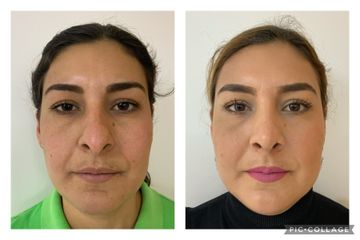 Rinoplastia - Cp Facial