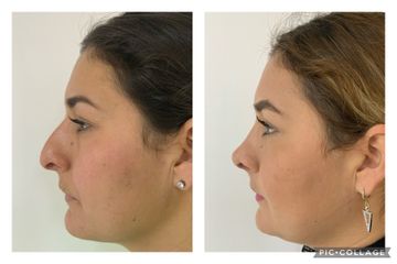 Rinoplastia - Cp Facial