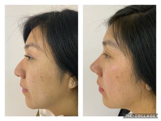 Rinoplastia - Cp Facial