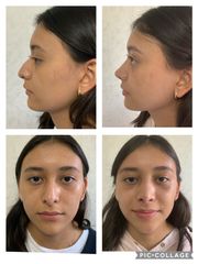 Rinoplastia - Cp Facial