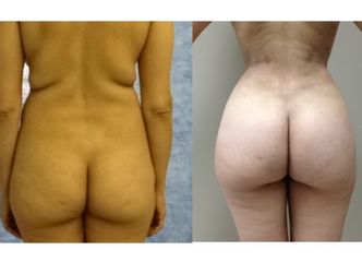 Antes y después de Lipoescultura