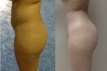 Antes y después de Lipoescultura