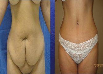 Antes y después de Abdominoplastia