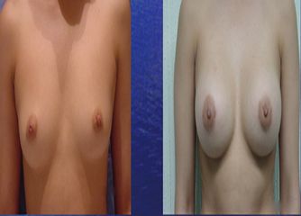 Antes y después de Aumento de busto