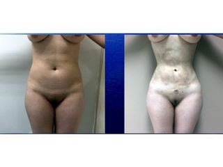 Antes y después de Lipoescultura