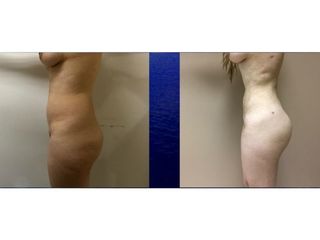 Antes y después de Lipoescultura