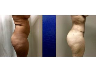Antes y después de Lipoabdominoplastia