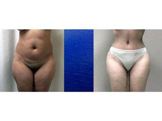Antes y después de Lipoabdominoplastia