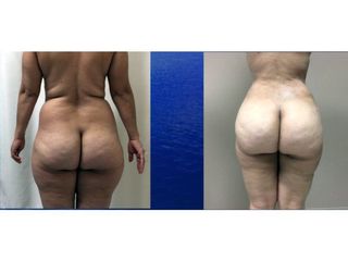 Antes y después de Lipoabdominoplastia