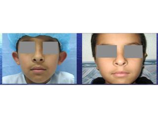 Antes y después de Otoplastia