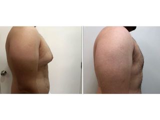 Antes y después de Ginecomastia