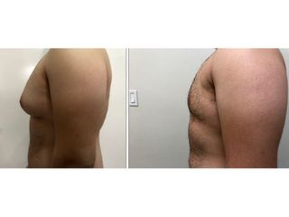 Antes y después de Ginecomastia