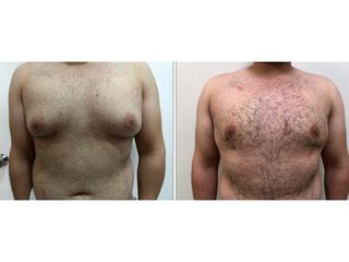 Antes y después de Ginecomastia