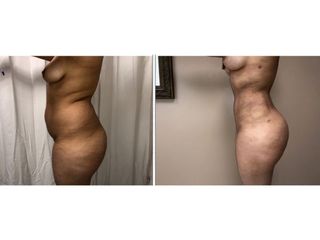 Antes y después de Lipoabdominoplastia