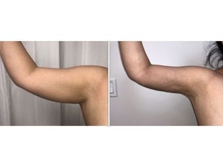 Antes y después de Braquioplastia