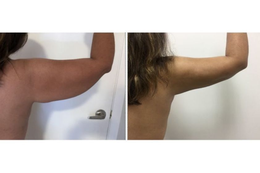 Braquioplastia antes y después - 636499