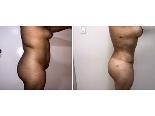 Antes y después de Lipoabdominoplastia